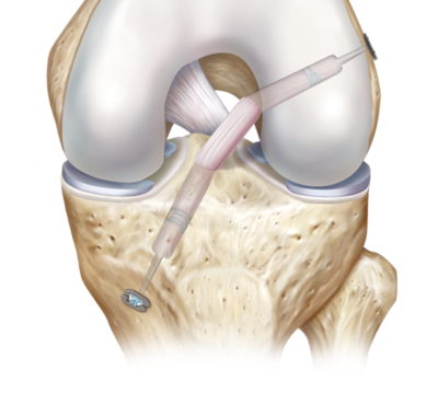 Operation ligament croisé antérieur ischio jambiers Marseille