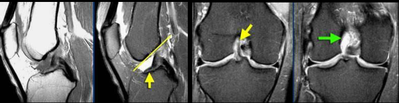 Reconstruction du ligament croisé antérieur par Demi-Tendineux ...