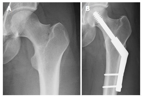 Prothèse de Hanche Fracture col du Fémur Marseille